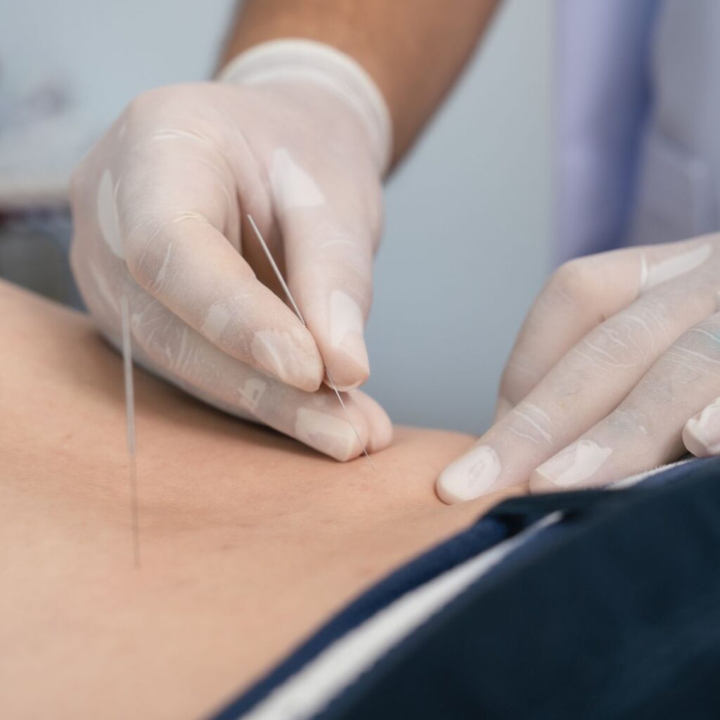 Close-up of a person receiving acupuncture; a practitioner in white gloves inserts thin needles into the skin of a patient’s lower back.