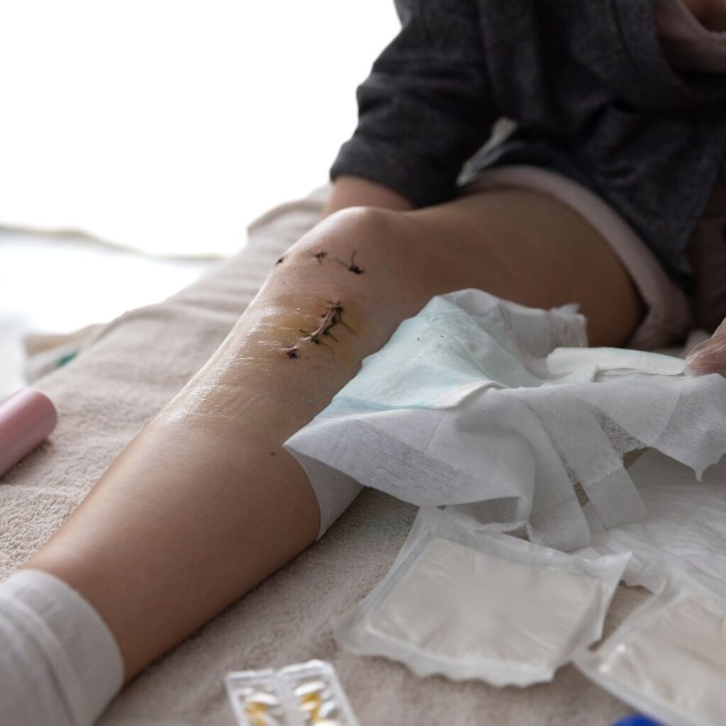 A person with a stitched surgical wound on their knee sits on a bed, surrounded by medical supplies such as gauze pads and bandages. The leg appears to be in the process of wound care or dressing change.
