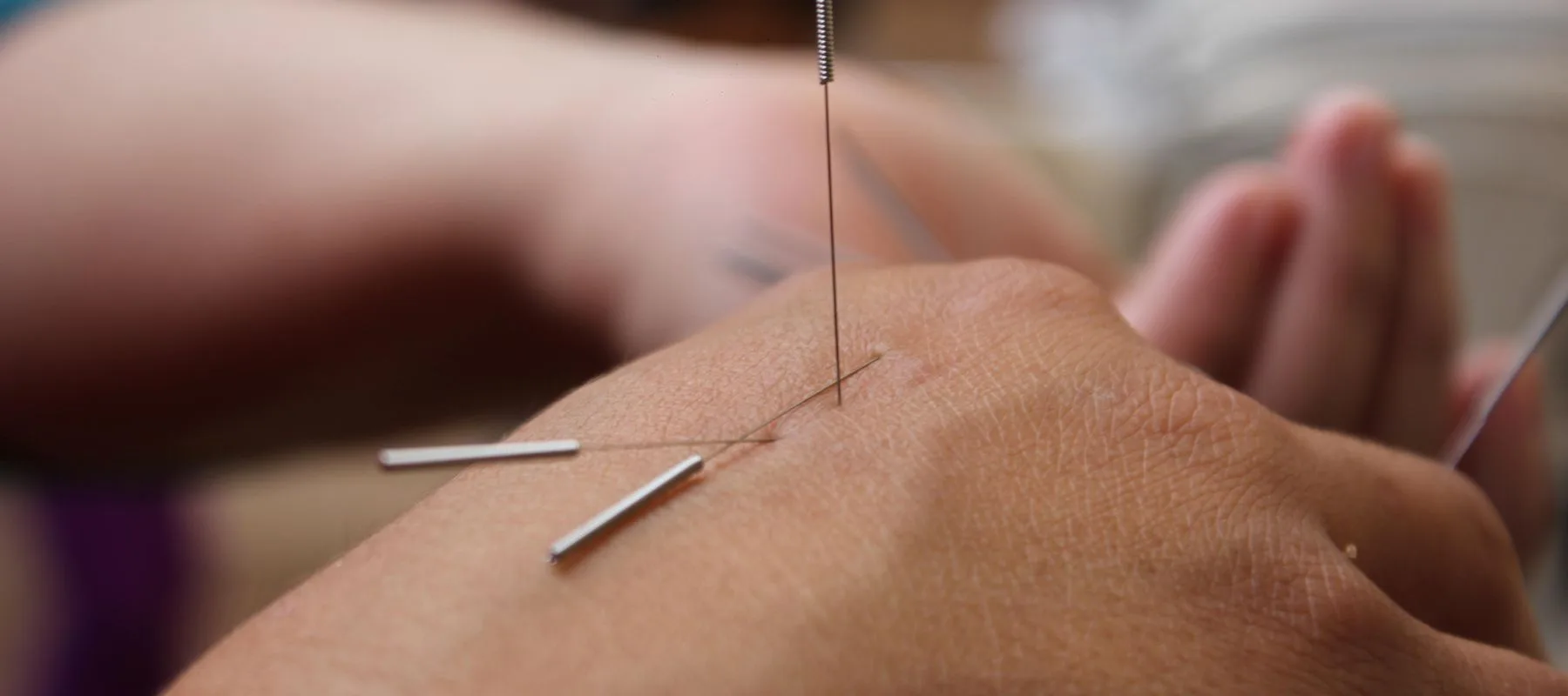 DIY Tips To Support Recovery After Dry Needling