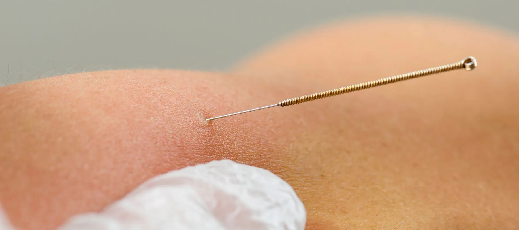 Dry Needling Therapy